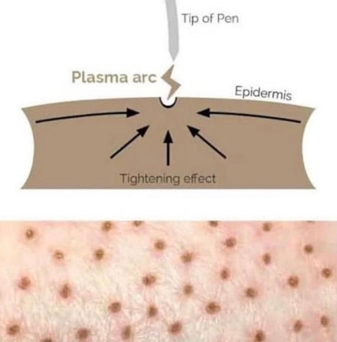 protocolo plasma fibroblast